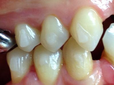 Réalignement des dents par gouttières invisibles